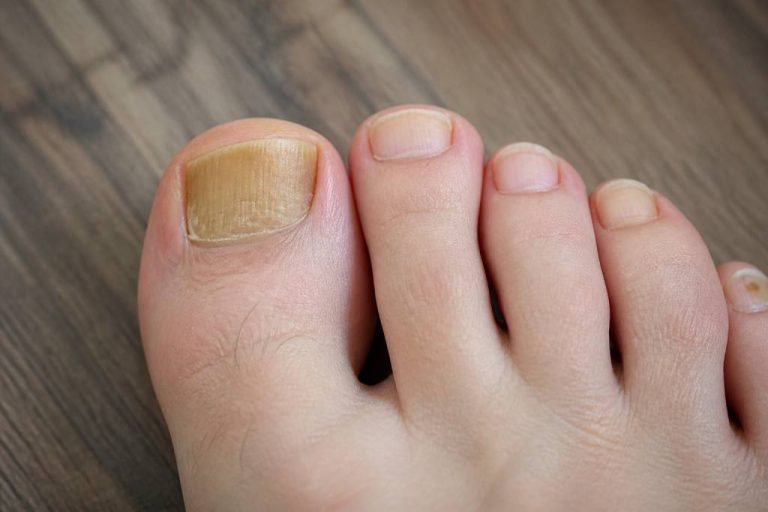 Why are my toenails yellow: causes, symptoms and treatment options